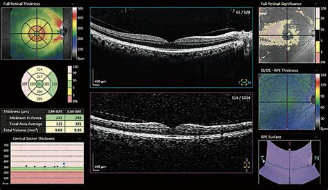 thickness measurement of retina|retinal images for eye disease.